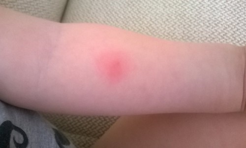 Аллергия после пробы Манту Аллергия после пробы Манту