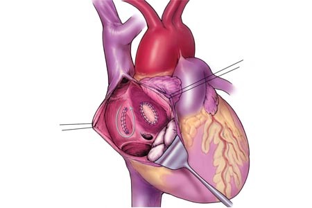 Аневризма МПП и методы её лечения у новорожденного ребёнка Аневризма МПП и методы её лечения у новорожденного ребёнка