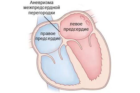 Аневризма МПП и методы её лечения у новорожденного ребёнка Аневризма МПП и методы её лечения у новорожденного ребёнка