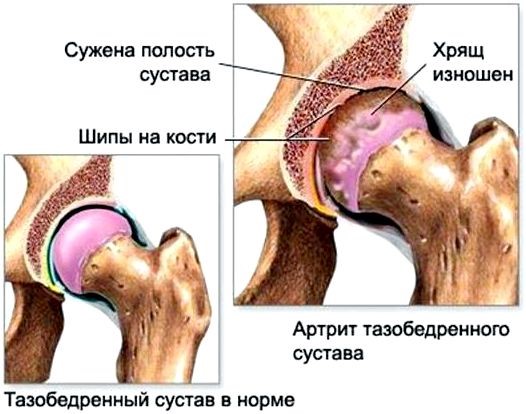 Артрит тазобедренного сустава у взрослых и детей: симптомы и лечение Артрит тазобедренного сустава у взрослых и детей: симптомы и лечение