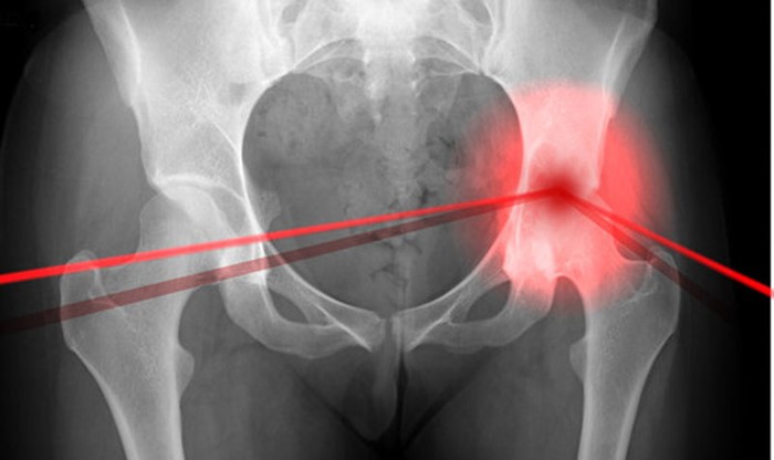 Артрит тазобедренного сустава у взрослых и детей: симптомы и лечение Артрит тазобедренного сустава у взрослых и детей: симптомы и лечение