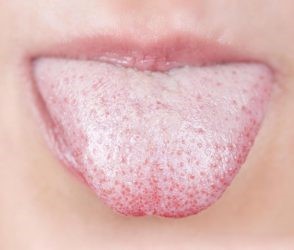 Почему возникает белый налет в горле: выясняем причину Почему возникает белый налет в горле: выясняем причину