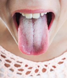 Почему возникает белый налет в горле: выясняем причину Почему возникает белый налет в горле: выясняем причину