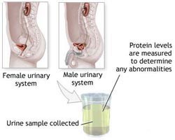Белок в моче после родов: причины, что это значит? Белок в моче после родов: причины, что это значит?