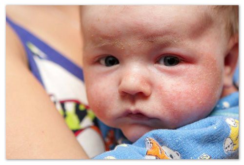 Как применять Бифиформ Беби: инструкция, состав, аналоги Как применять Бифиформ Беби: инструкция, состав, аналоги