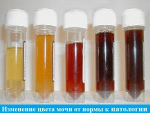 Резкая боль в левом боку со спины Резкая боль в левом боку со спины