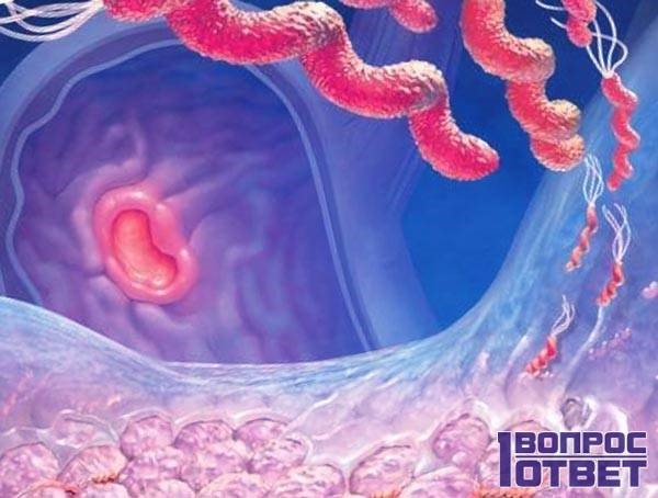 Что такое бульбит желудка? Что такое бульбит желудка?