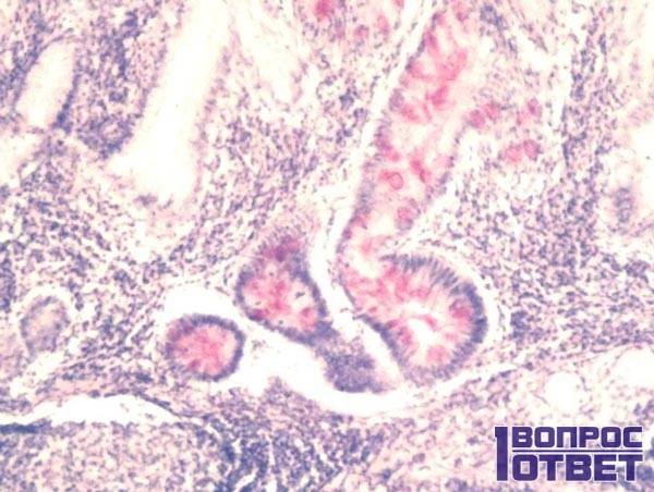 Что такое бульбит желудка? Что такое бульбит желудка?