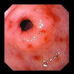 Как проявляется и лечится гастрит эритематозный? Как проявляется и лечится гастрит эритематозный?