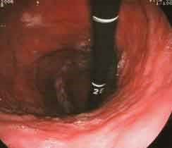 Как проявляется и лечится гастрит эритематозный? Как проявляется и лечится гастрит эритематозный?