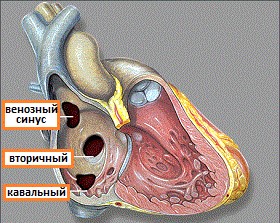 Причины возникновения и особенности лечения дефекта межпредсердной перегородки Причины возникновения и особенности лечения дефекта межпредсердной перегородки