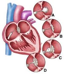 Причины возникновения и особенности лечения дефекта межпредсердной перегородки Причины возникновения и особенности лечения дефекта межпредсердной перегородки