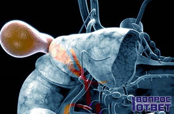 Правильные способы лечения деформации желчного пузыря Правильные способы лечения деформации желчного пузыря