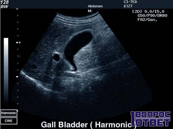 Правильные способы лечения деформации желчного пузыря Правильные способы лечения деформации желчного пузыря