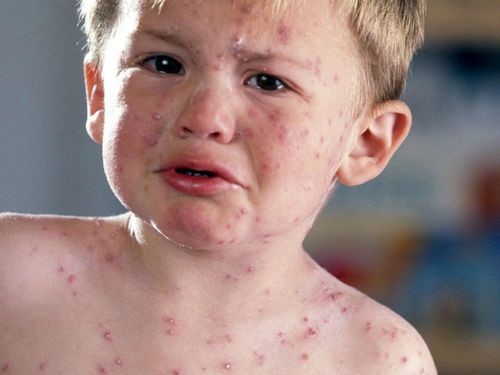 Прививка от скарлатины: когда делают детям Прививка от скарлатины: когда делают детям