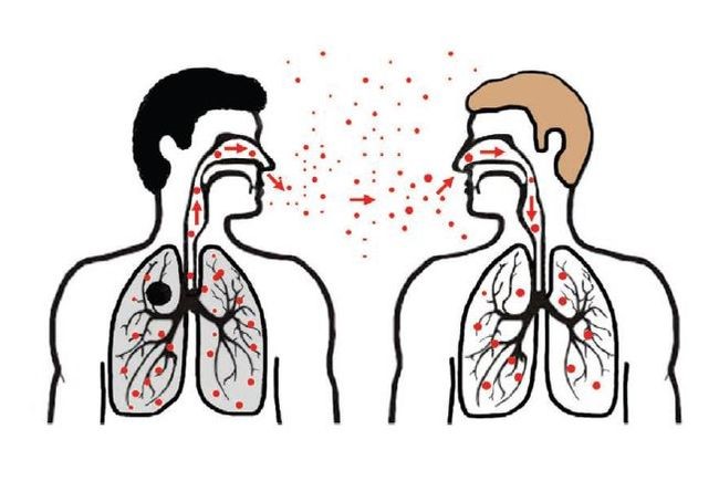 Дифтерия: симптомы у взрослого Дифтерия: симптомы у взрослого
