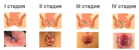 Список обезболивающих свечей при геморрое Список обезболивающих свечей при геморрое