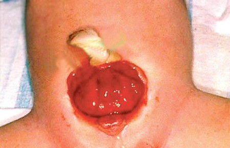 Что такое экстрофия мочевого пузыря? Что такое экстрофия мочевого пузыря?