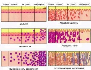 Фундальный гастрит Фундальный гастрит