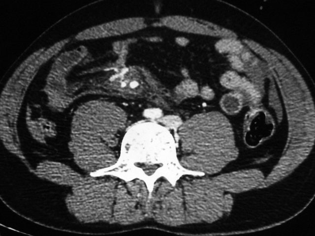 Особенности гастроскопии желудка без глотания зонда Особенности гастроскопии желудка без глотания зонда