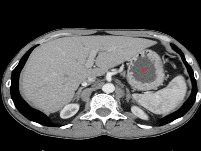 Особенности гастроскопии желудка без глотания зонда Особенности гастроскопии желудка без глотания зонда