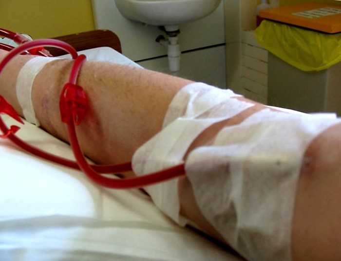 Для чего применяется гемодиализ почек Для чего применяется гемодиализ почек