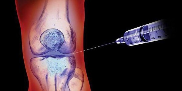 Применение препаратов гиалуроновой кислоты для суставов, их эффективность Применение препаратов гиалуроновой кислоты для суставов, их эффективность