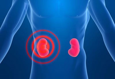 Причины и лечение гидронефроза почек Причины и лечение гидронефроза почек