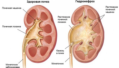 Причины и лечение гидронефроза почек Причины и лечение гидронефроза почек