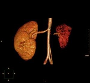 Особенности гипоплазии позвоночных артерий (правой и левой) Особенности гипоплазии позвоночных артерий (правой и левой)