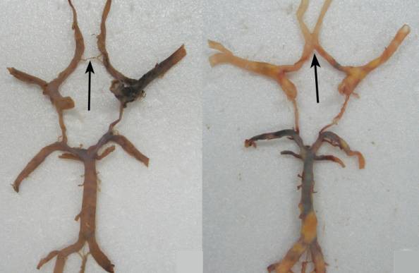 Гипоплазия позвоночных артерий Гипоплазия позвоночных артерий