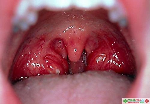 Гнойники на гландах: причины и симптомы патологии Гнойники на гландах: причины и симптомы патологии