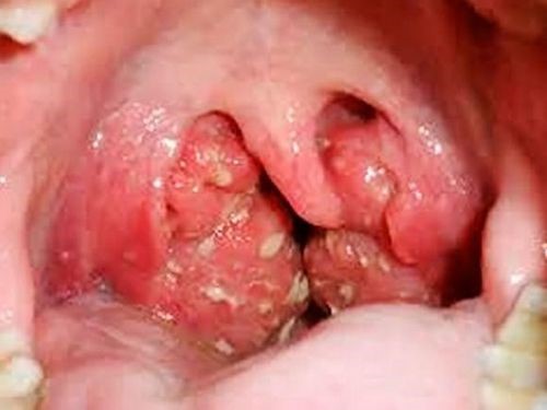 Гнойники на гландах: причины и симптомы патологии Гнойники на гландах: причины и симптомы патологии