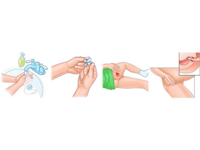 Свечи ректальные противовоспалительные: показания к применению и действие Свечи ректальные противовоспалительные: показания к применению и действие