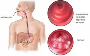 Гастрит: симптомы обострения и методы лечения Гастрит: симптомы обострения и методы лечения