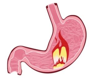 Гастрит: симптомы обострения и методы лечения Гастрит: симптомы обострения и методы лечения