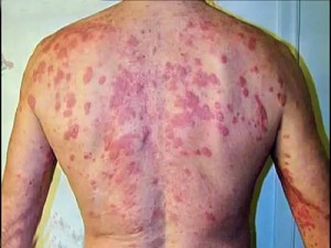 Аналоги Цефтриаксона в уколах, таблетках: Цефотаксим, Роцефин, Цефазолин и другие Аналоги Цефтриаксона в уколах, таблетках: Цефотаксим, Роцефин, Цефазолин и другие