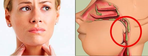 Как избавиться от слизи в носоглотке с помощью промывания? Как избавиться от слизи в носоглотке с помощью промывания?