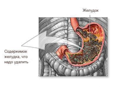 Как правильно в домашних условиях промыть желудок Как правильно в домашних условиях промыть желудок