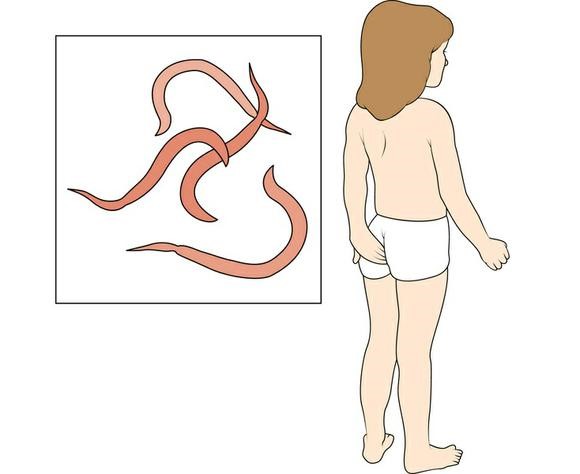 Как берется соскоб на энтеробиоз? Как берется соскоб на энтеробиоз?