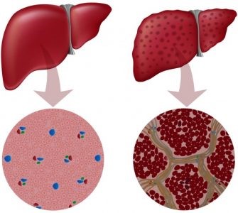 Кальциноз печени: причины, симптомы, профилактика Кальциноз печени: причины, симптомы, профилактика