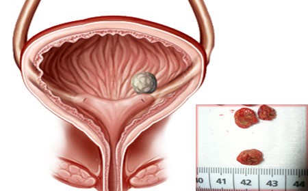 Самые эффективные методы лечения камней в мочевом пузыре Самые эффективные методы лечения камней в мочевом пузыре
