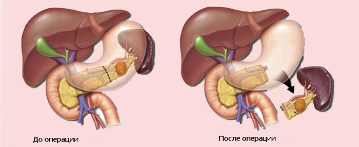 Как избавиться от камней в поджелудочной железе? Как избавиться от камней в поджелудочной железе?