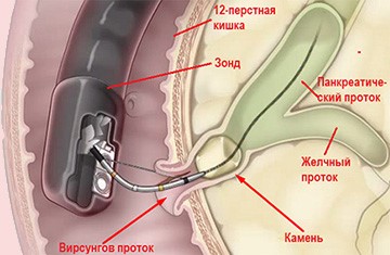 Как избавиться от камней в поджелудочной железе? Как избавиться от камней в поджелудочной железе?
