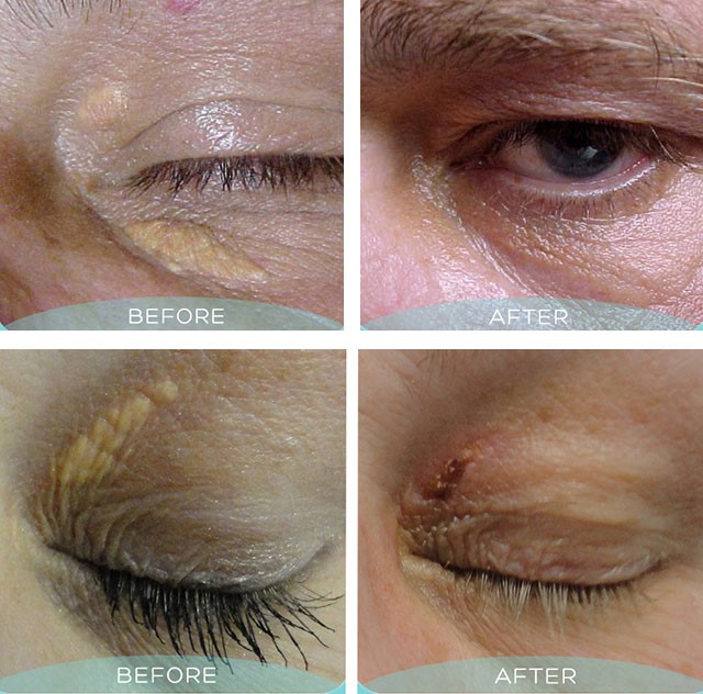 Причины возникновения и удаление холестериновых бляшек на веках Причины возникновения и удаление холестериновых бляшек на веках