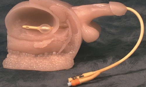 Как проводится катетеризация мочевого пузыря у женщин Как проводится катетеризация мочевого пузыря у женщин