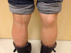 Киста подколенной ямки: лечение кисты Бейкера в подколенной области Киста подколенной ямки: лечение кисты Бейкера в подколенной области