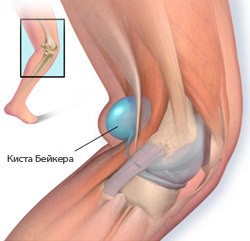 Киста подколенной ямки: лечение кисты Бейкера в подколенной области Киста подколенной ямки: лечение кисты Бейкера в подколенной области