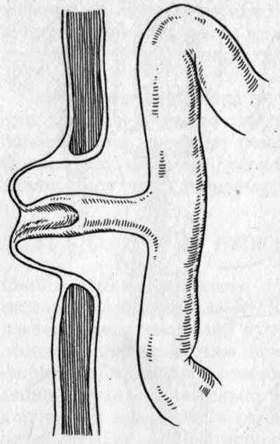 Как у женщин проявляется киста урахуса? Как у женщин проявляется киста урахуса?