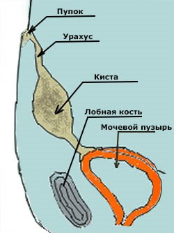 Как у женщин проявляется киста урахуса? Как у женщин проявляется киста урахуса?